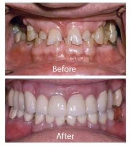 Braces Treatment