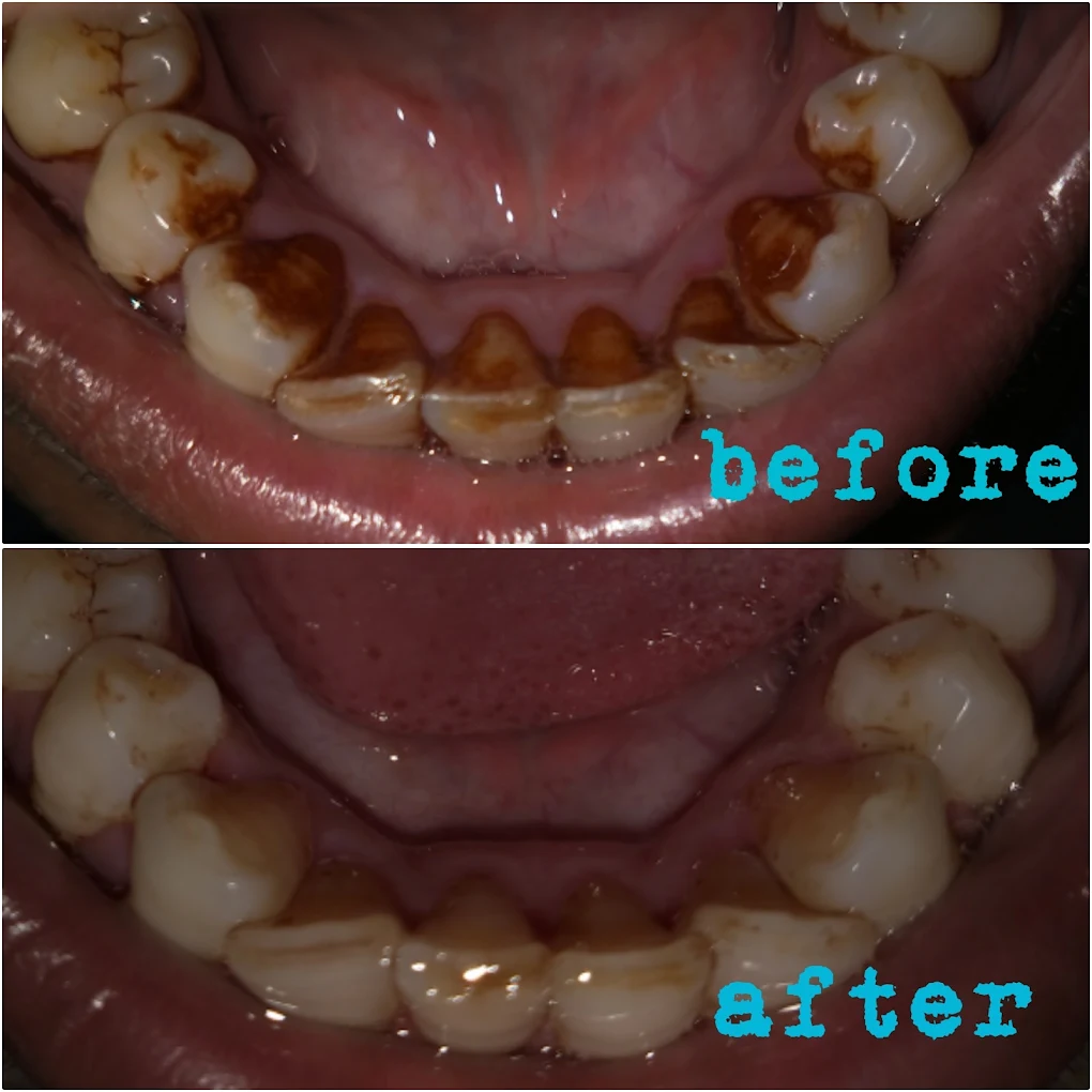 Complete Smile Makeover