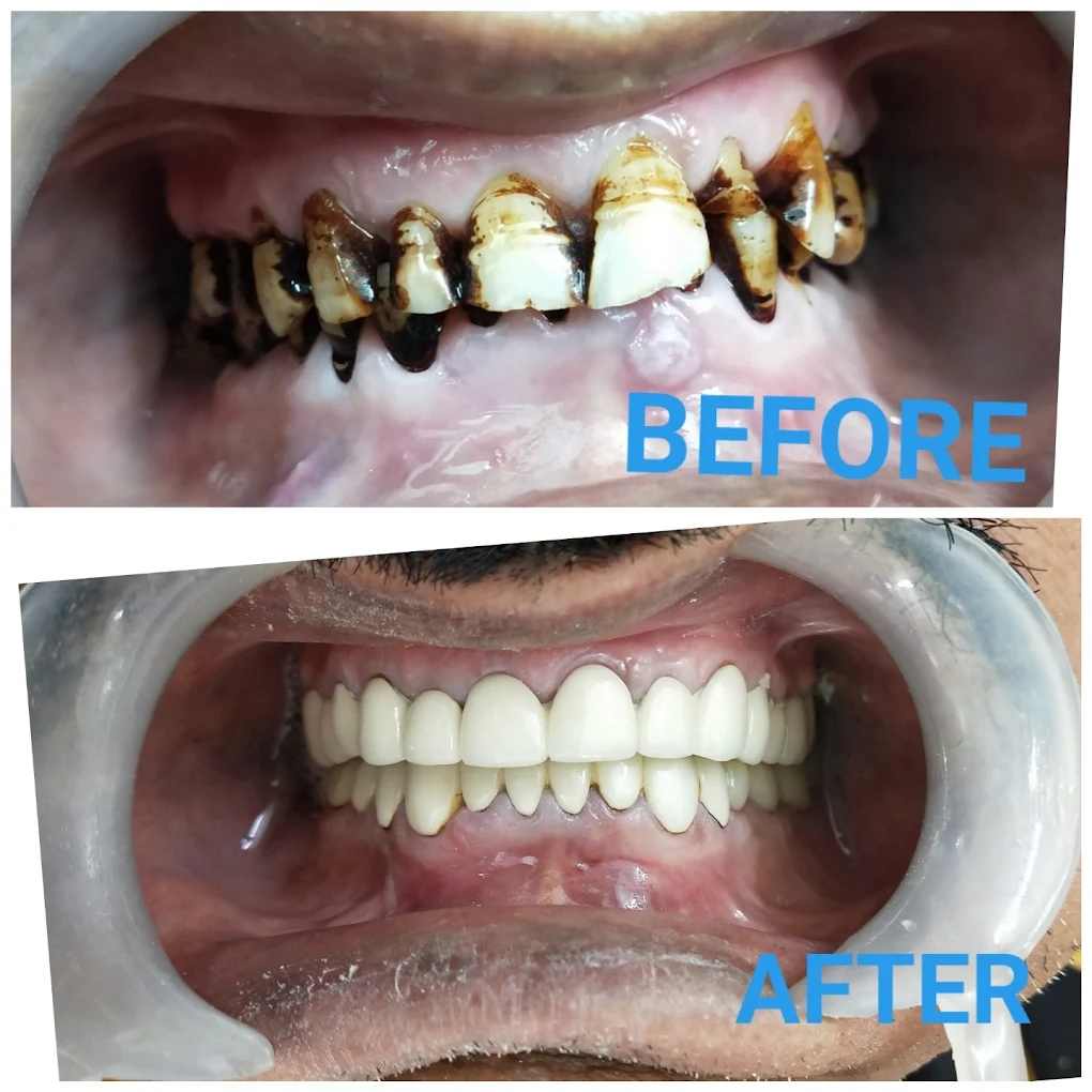 Teeth Whitening