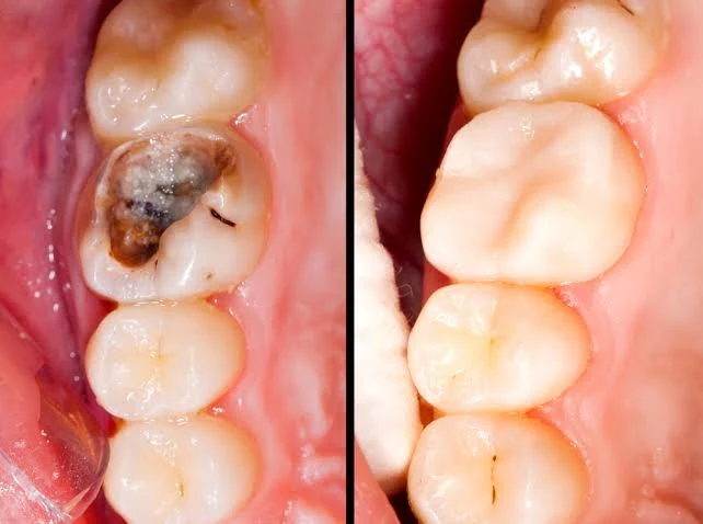 5 Signs You Need a Root Canal