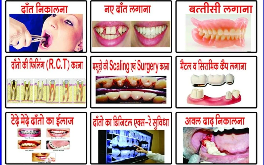 Benefits of Dental Implants