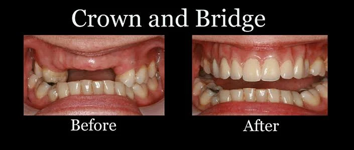 Foods for Healthy Teeth