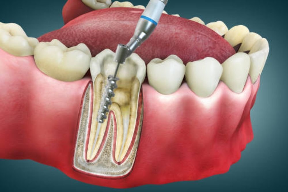 Root Canal