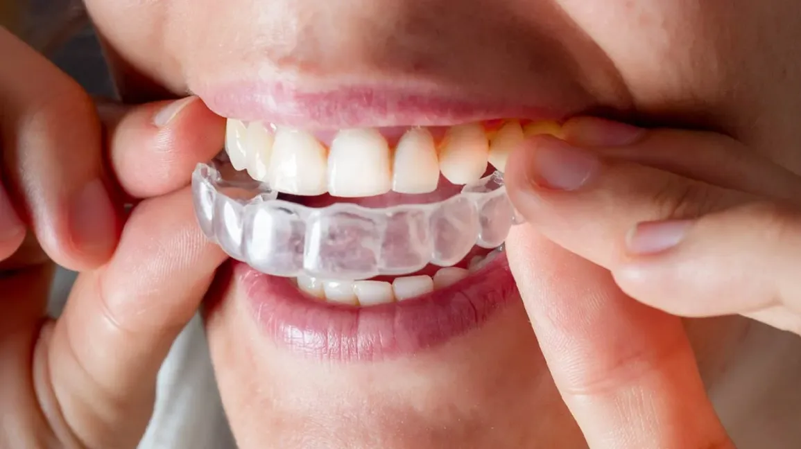 Invisalign Aligners